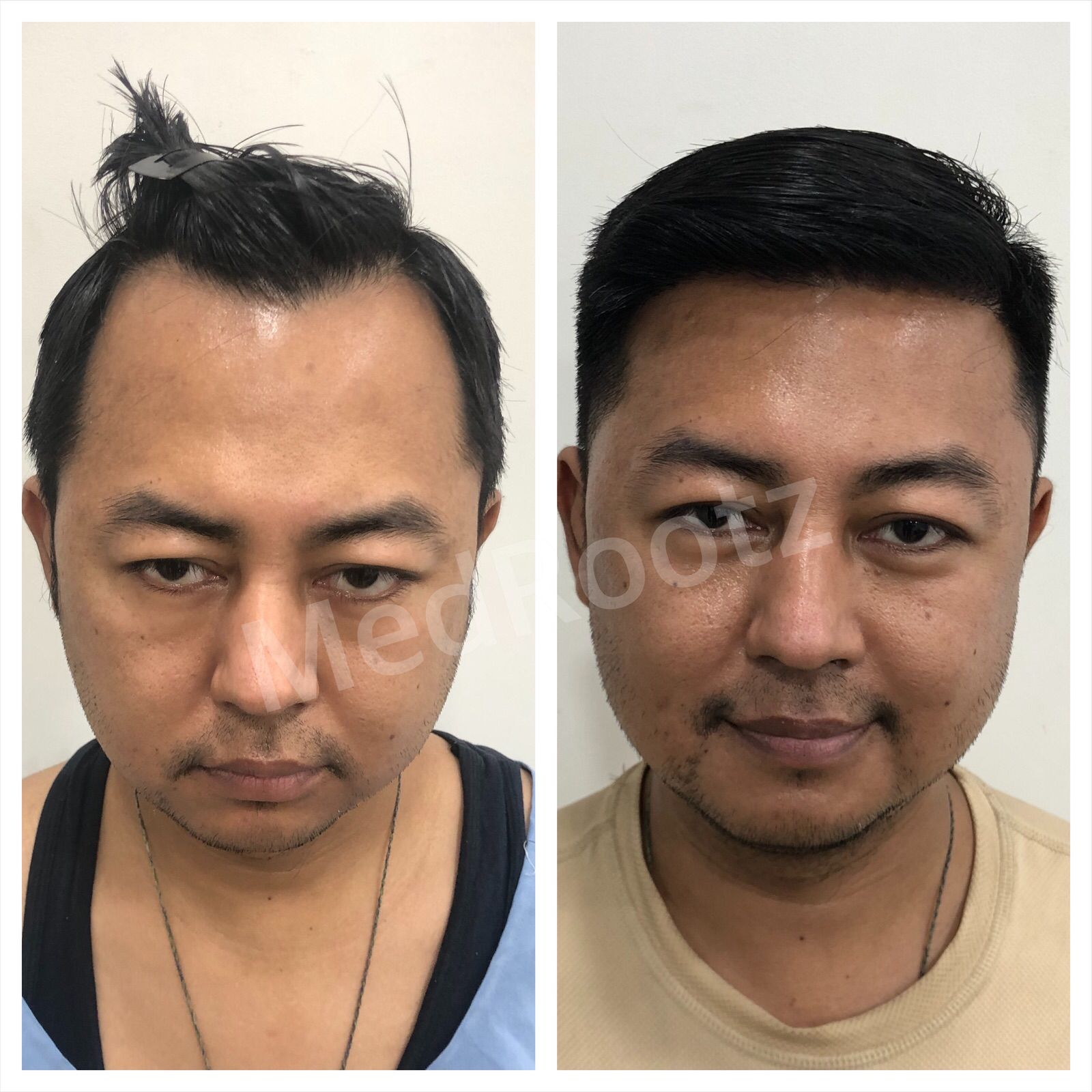Best hair transplant doctor in delhi